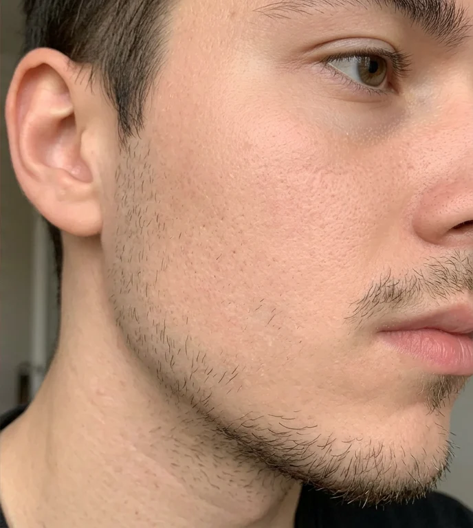 After using Anti-Acne Serum